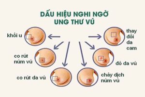  Dấu hiệu Ung Thư Vú