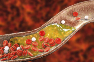 cholesterol cao