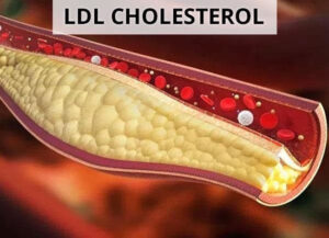 ldl cholesterol là gì