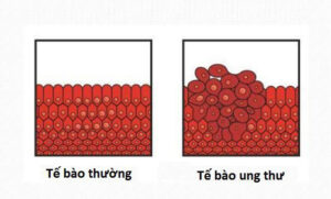 tế bào ung thư và tế bào thường